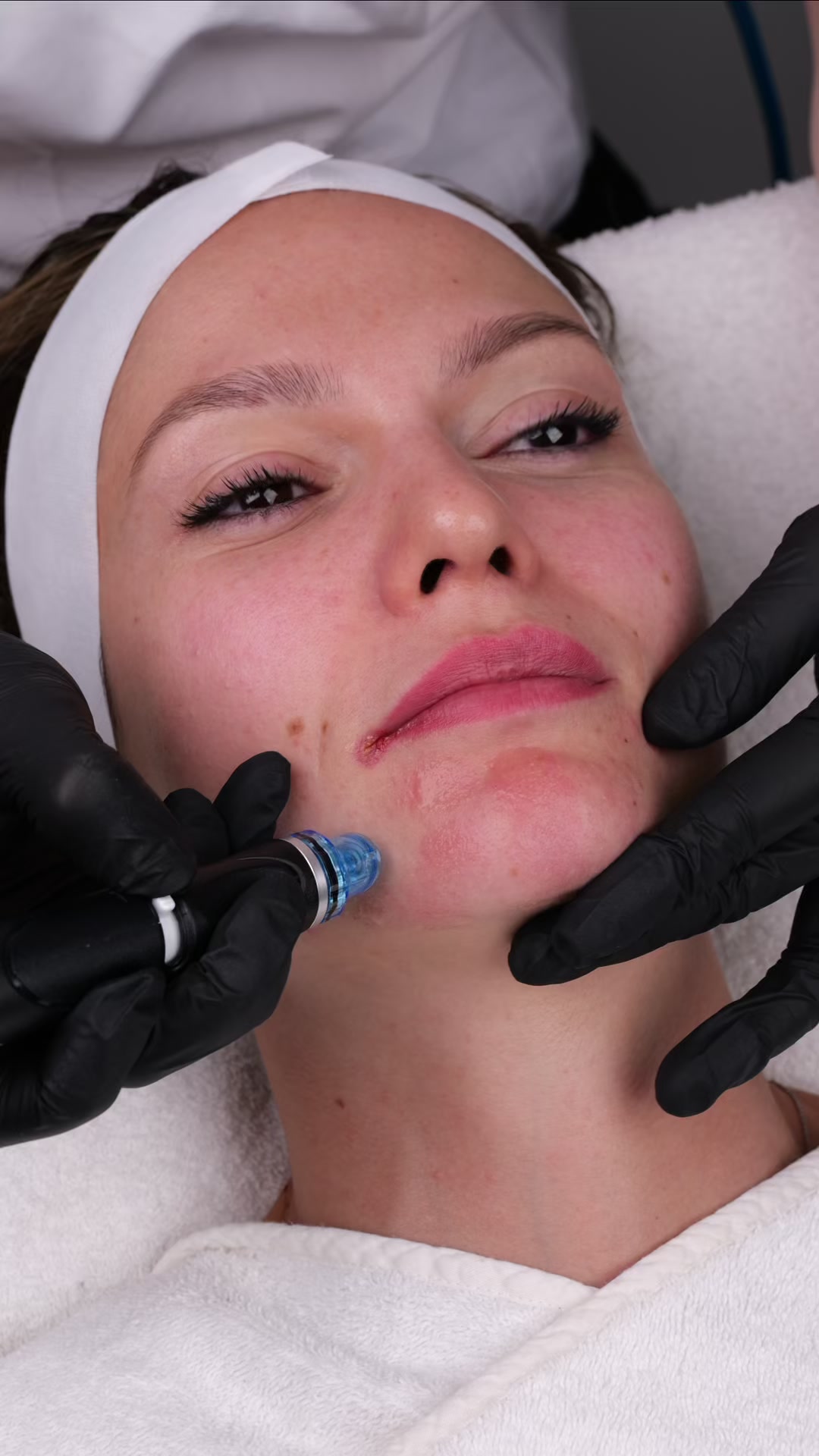 HydraFacial djuprengöring hos DH Beauty Lounge Malmö