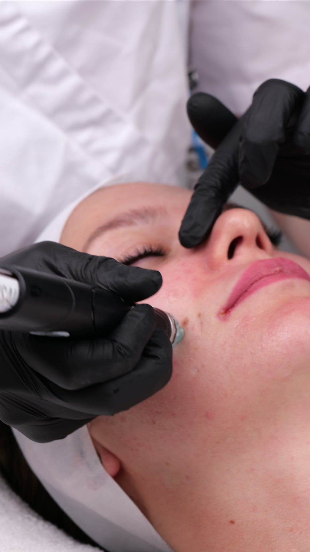 HydraFacial hudstruktur förbättring hos DH Beauty Lounge Malmö