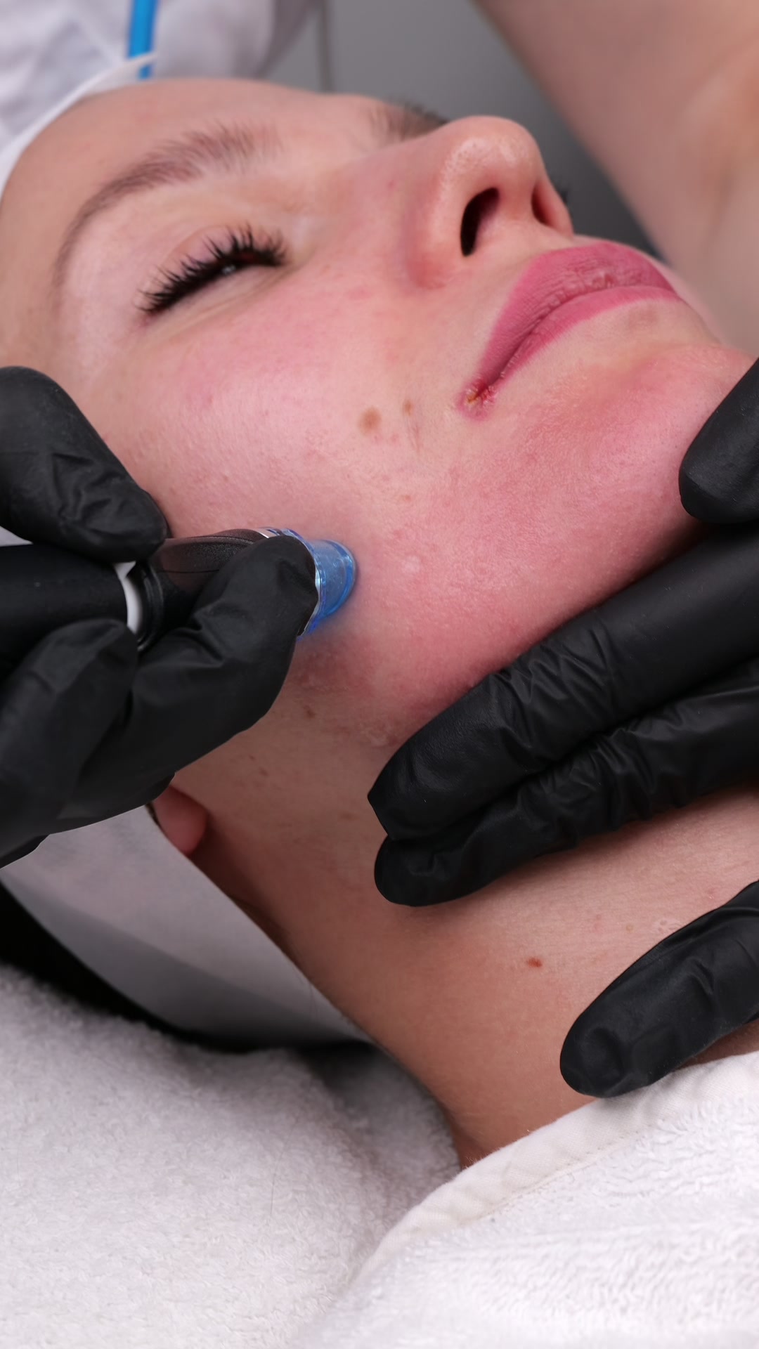 HydraFacial lysande hudton hos DH Beauty Lounge Malmö